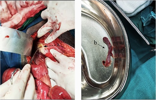 Intraoperative findings of a pinpoint perforation at the anterior aspect of the pyloric antrum (A); a consequent appendectomy was done, with the imaging (B) showing the removed appendix.