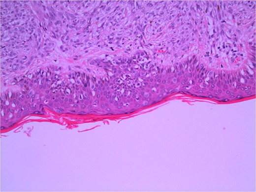 Wide local excision of primary lesion demonstrating pagetoid spread in epidermis and infiltration into reticular dermis; H&E × 200 magnification.