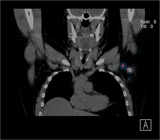 CT SPECT image identifying two SLNs in the left axilla.