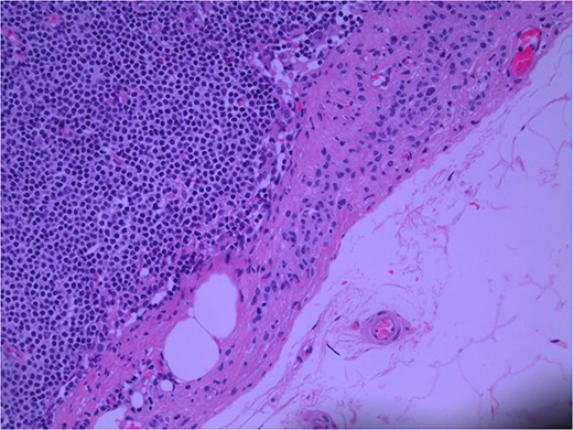 Lymph node; nevoid melanocytes in subcapsular region; H&E × 200 magnification.