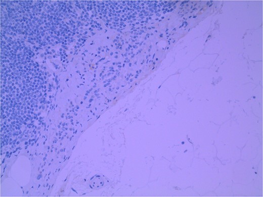 Lymph node with IHC using HMB-45 stain, not staining subcapsular region melanocytic cells; × 200 magnification.