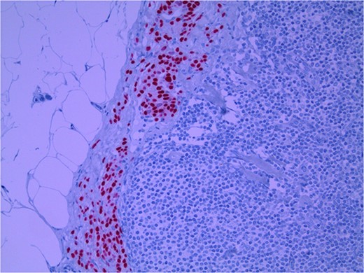Lymph node with IHC using Sox 10 stain, staining melanocytic cells (benign or malignant) in subcapsular region; × 200 magnification.