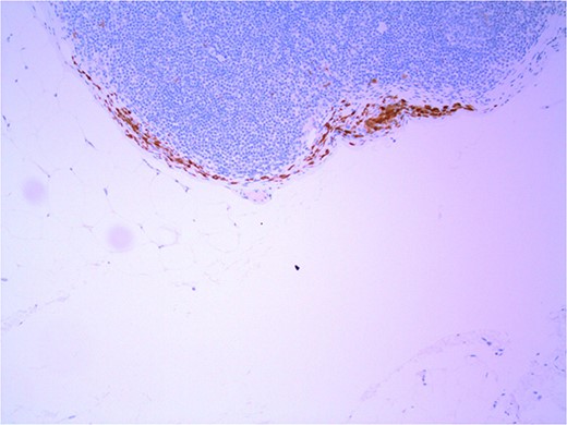 Lymph node with IHC using p16 stain, staining nevoid melanocytes; × 100 magnification.