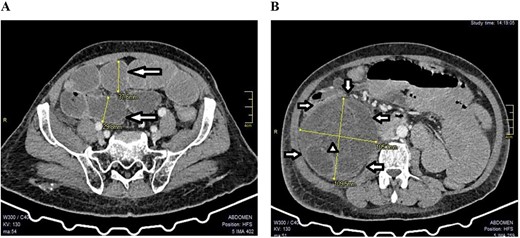 A CT scan showed features of intestinal obstruction around the paracecal site with dilated small bowel loops; (A) the various dilated small bowel loops (arrows) can be seen; (B) the hernia sac (arrows) with dilated bowel loops inside (arrow head) were seen around the cecum (axial images).