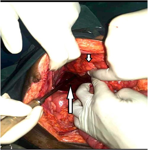 Large retroperitoneal paracecal pouch (long arrow) and the cecum above it (short arrow).