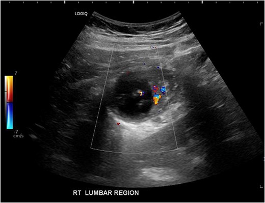 Ultrasound image demonstrating a cystic lesion with internal calcification and no hypervascularity.