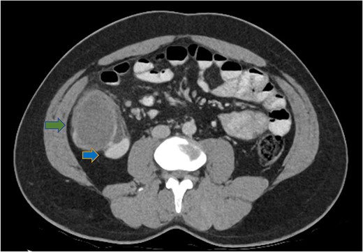 Axial CT abdomen demonstrating a cystic submucosal lesion at the right colon (green arrow). There is involvement of the colonic lumen but no obstruction with oral contrasting passing through the lumen (blue arrow).