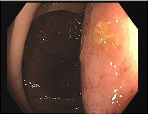 Colonoscopy view of the colonic duplication cyst.