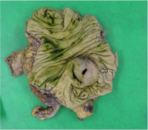 Macroscopic view of specimen post-fixation, with duplication cyst visible at lower right within caecum (arrow).