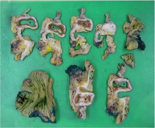 Dissection of specimen; duplication cyst (asterisk) with adjacent bowel wall visible.