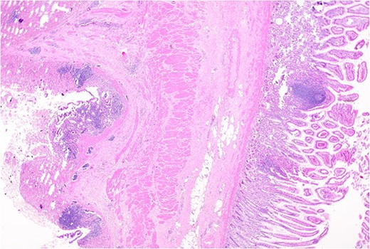 Remnant of normal colonic epithelium (left) within the duplication cyst that shares common muscularis propria with the terminal ileum (right), low power.