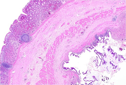 Area of dysplastic mucosa (right) within the duplication cyst that shares a common wall with the right colon (left), low power.