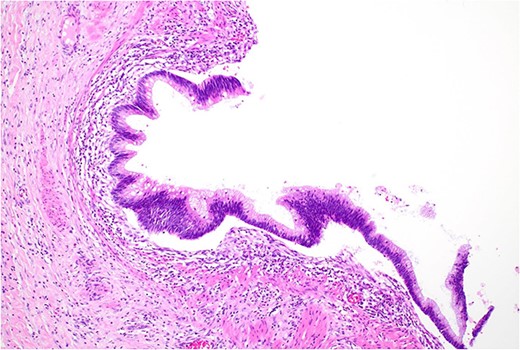 Low grade dysplasia in duplication cyst epithelium, high power.