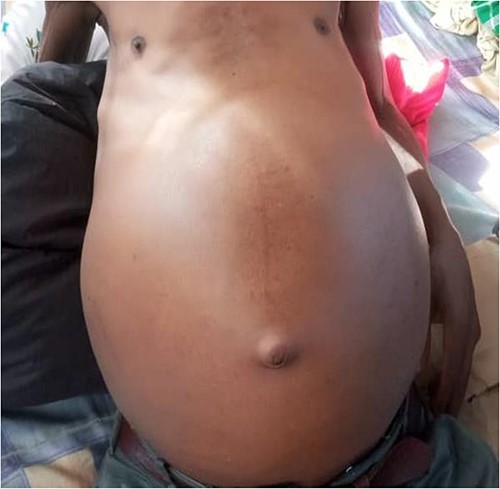 Gross appearance showing generalised abdominal distention with marked wasting.