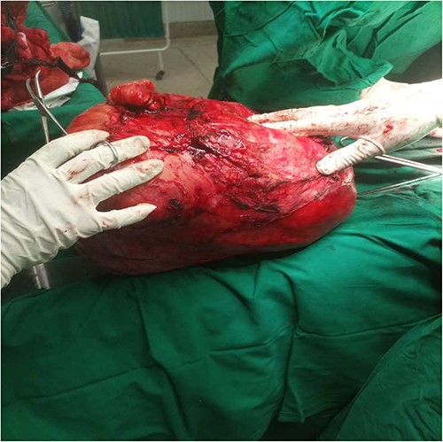 Intraoperative en bloc excision of a large intraabdominal mass originating from the posterior wall of the urinary bladder.