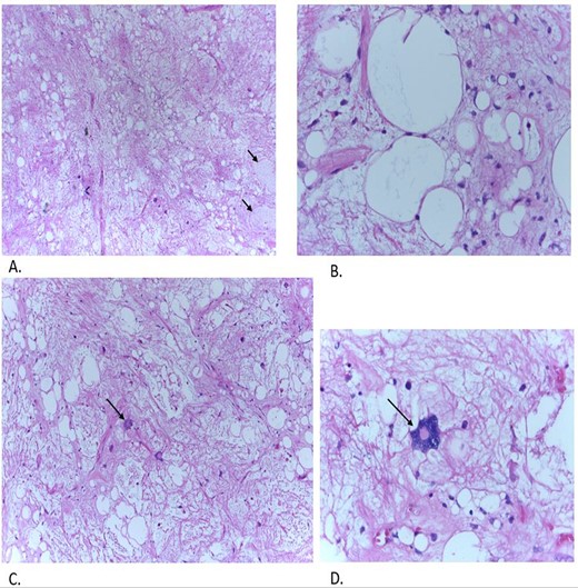 (A) Low power: paracellular tissue with collagenous stroma. (C) Intermediate power: fibrofatty tissue with abundant hyaline-like fibro collagenous fibers and mature adipocytes, scant scattered hyperchromatic cells. Arrow showing a visible giant floret cell. (B, D) High power: mature adipocytes of variable size, scattered hyperchromatic spindle cells and mast cells as well as large prominent giant floret cells (Dr Atuganile Malango, Dr Fadia Ali).