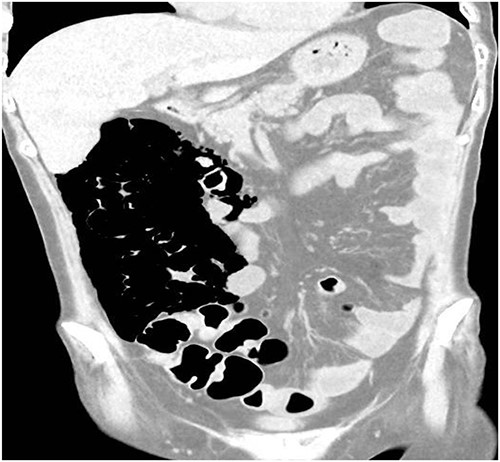 CT scan coronal view.