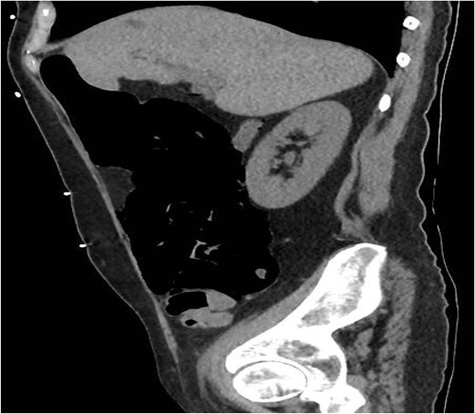 CT sagittal view.