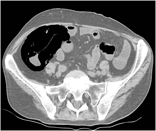 CT axial view.