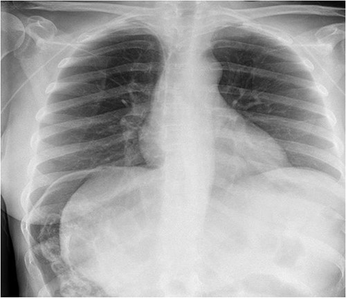 Chest X-ray.
