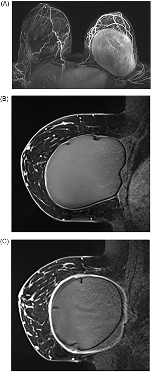MRI of breasts showing left capsular lesion. (A) T1-weighted delayed subtraction axial MRI of breasts demonstrating intracapsular rupture with scattered foci of signal abnormalities consistent with disruptions in the silicone-matrix. (B) T1-weighted contrast sagittal MRI of right breast demonstrating mild diffuse thickening of the fibrous capsule with no nodularity and no abnormal enhancement. (C) T1-weighted contrast sagittal MRI of left breast demonstrating intracapsular rupture. The implant shell demonstrates several folds and indurations with no gross disruption