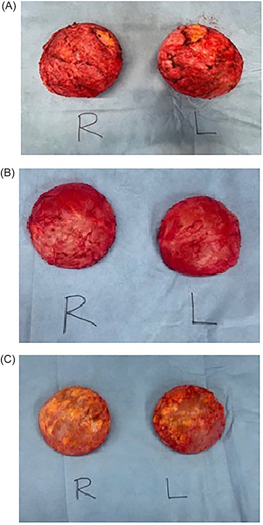 Intraoperative photos of bilateral breast implants. (A) Patient 1: right and left breast implant capsules. (B) Patient 2: right and left breast implant capsules. (C) Patient 3: right and left breast implant capsules
