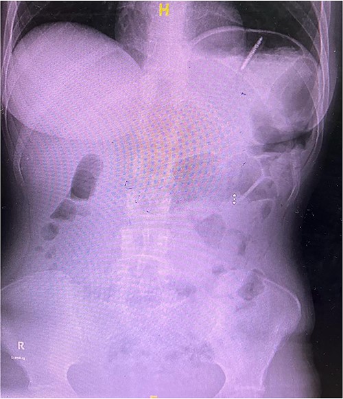 X-ray of abdomen showing the presence of a toothbrush at the left upper quadrant.