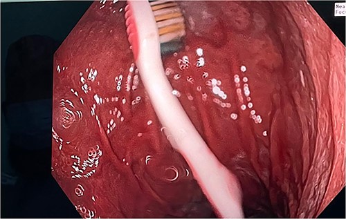 Toothbrush at the fundus of the stomach.