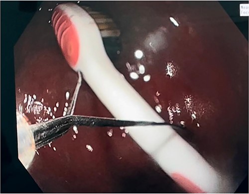 Toothbrush extraction via gastric balloon grasper.