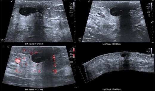 Ultrasound of the breast demonstrating a cystic structure adjacent to the nipple measuring approximately 17 mm × 11 mm × 8 mm with surrounding inflammatory changes and low-level internal echoes. No internal flow.