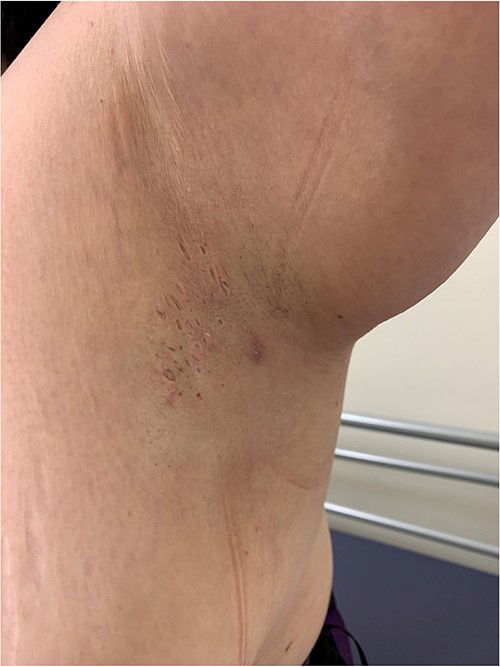 Atrophic scarring and sinus tracts present in the axillae.