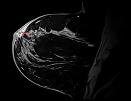 T1 Dixon sagittal MRI of the breast—changes restricted to the skin. Diffuse skin thickening of the periareolar region with small fluid collections (red arrow).