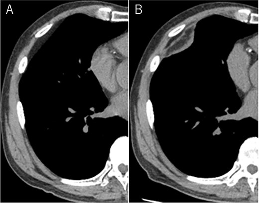 Mixed density mass located in front of thoracic wall; the size was 8.0 × 5.0 × 3.0 cm (B); (A) The tumor seen as thoracic wall fat (7.8 × 4.8 × 1.2 cm) (arrow) on CT 1 year ago; (B) the size increased and the density has changed to heterogenous in 1 year.