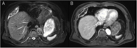 Chest MRI; (A) T2-weighted imaging showed several high signal foci in the tumor; (B) irregular marginal enhancement was observed.
