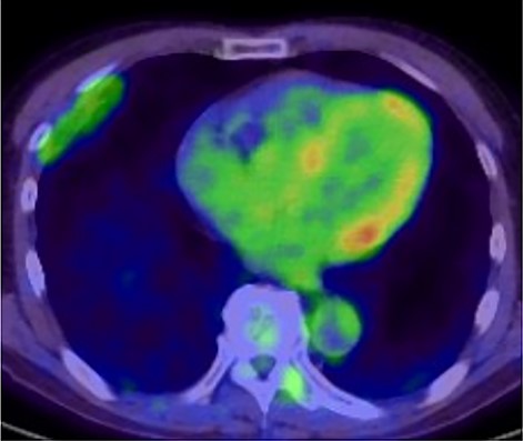 18F-FDG-PET uptake by the tumor; maximum standard uptake value was 3.78.
