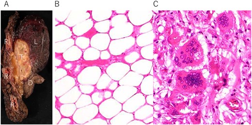 (A) Tumor (T) with fibrous adhesion between ribs (R), lung (L) and diaphragm (D); (B) matured fat tissue consist the tumor; (C) marginal area of the tumor fat necrosis and inflammatory changes with foamy macrophage and multinucleated giant cells.