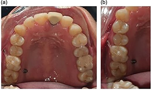 Placement of the miniscrews: (a) on the buccal side between the second premolar and the first molar and (b) on the palatal side between the first and the second molars; composite button on the occlusal surface to direct the forces along the long axis.