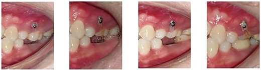 The intrusion process with placement of the prosthetic crown at the completion stage.