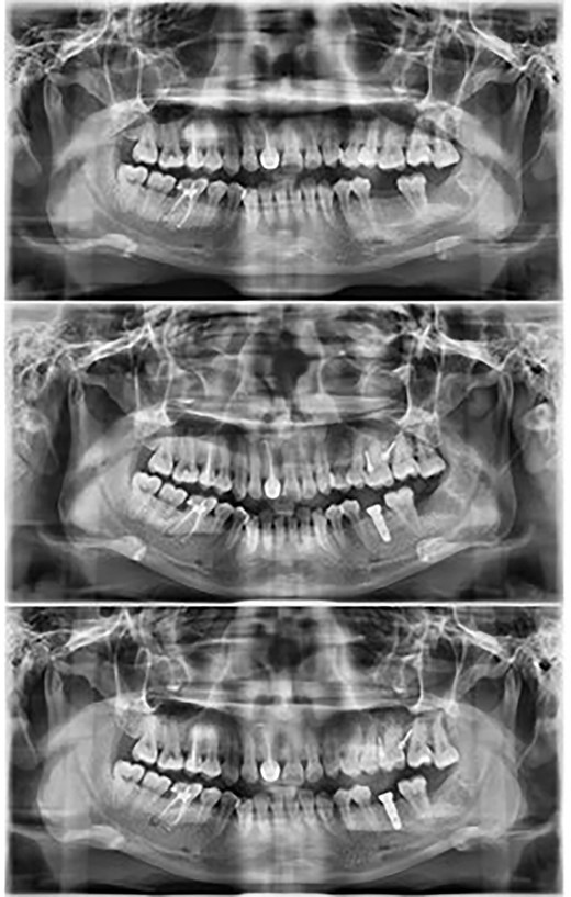 Panoramic radiographs show the intrusion process along with placement of the implant in the opposing arch.