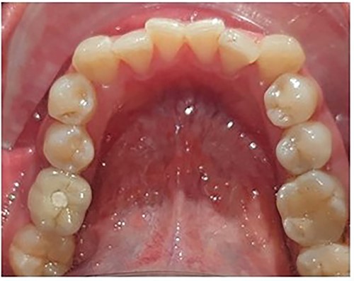 Full coverage crown placed on the implant to replace the mandibular first molar.