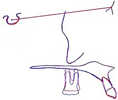The cephalometric super-imposition denoting intrusion.