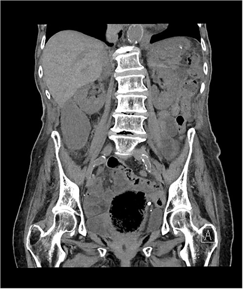 Axial slice of non-contrast CT abdomen and pelvis, demonstrating a distended gallbladder located outside the typical anatomical location, inferior the liver edge, causing medial displacement of the right kidney.