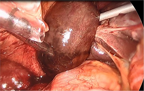Intraoperative picture of a gangrenous, floating gallbladder.
