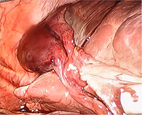 Gallbladder after being un-torted, showing the long cystic pedicle.