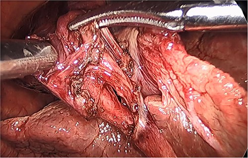 Intraoperative picture of the critical view following dissection of the cystic duct and artery.