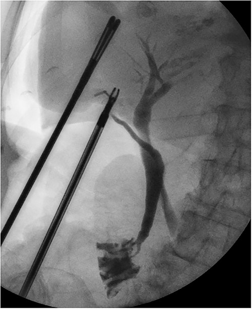 Intraoperative cholangiogram showing a long tortuous cystic duct with a medial insertion into the common bile duct.