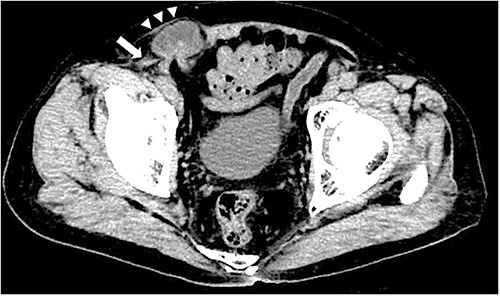 Contrast-enhanced CT scan; an incarcerated bowel was observed in the right inguinal region; the small bowel was incarcerated between internal and external oblique muscles; the white arrow indicates the internal oblique muscle, and the white triangles indicate the external oblique muscle.