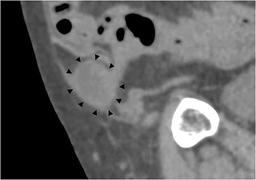 Sagittal section of contrast-enhanced CT; the black triangles indicate the incarcerated small bowel.