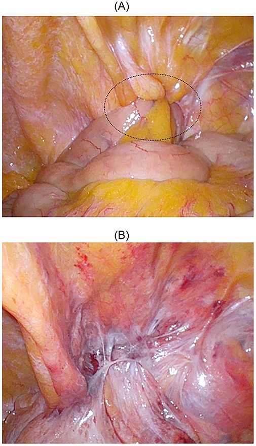 Intraoperative findings; the small bowel was incarcerated; the dotted circle indicates the peritoneal swelling by hernia contents (A); after manupulation, the hernial orifice could not be found (B).
