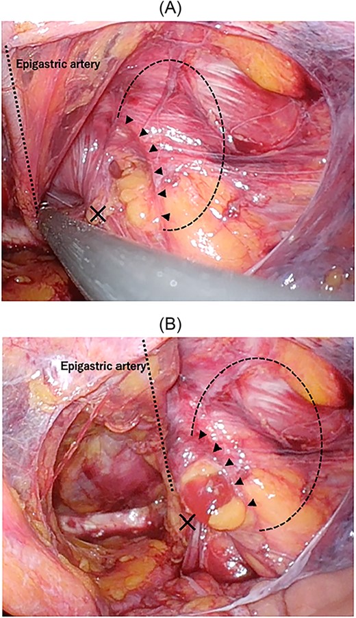 Intraoperative findings of right inguinal region after peritoneal incision; the black triangles show the hernial orifice; the dotted circle indicates the assumed hernia sac; the black cross indicates the internal inguinal ring (A); by pressing the inguinal region from the body surface, intermuscular soft tissue was prolapsed into the abdominal cavity (B).